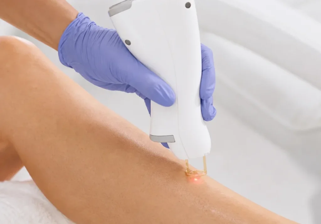 Close-up of a laser hair removal pulse on the leg — the gold contact tip and red aiming light on the skin — at Bogat Aesthetics & Wellness in Hallandale Beach, FL.
