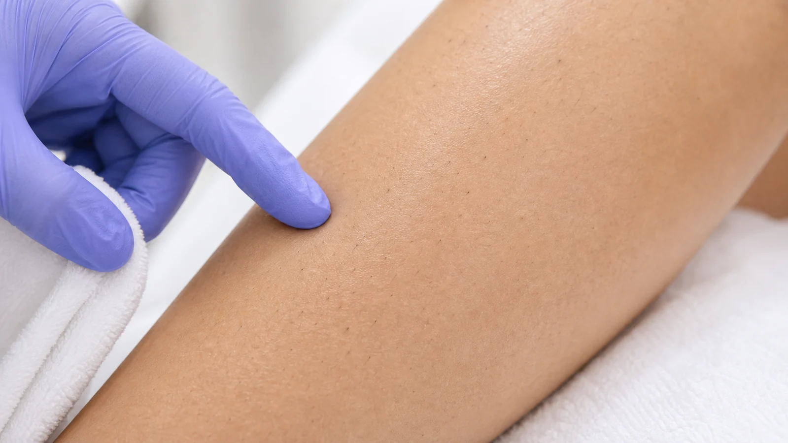 A gloved hand pointing to a client's leg after laser hair removal, where treated hairs are shedding as fine dark dots in the skin, at Bogat Aesthetics & Wellness in Hallandale Beach, FL.
